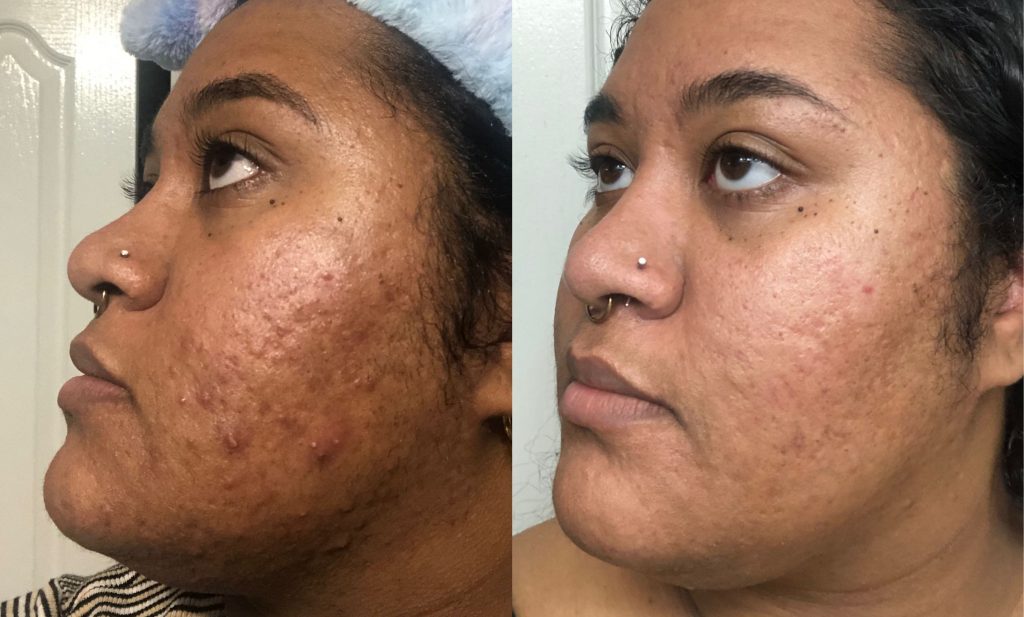 Acne Skin Journey: Deja, 26, USA