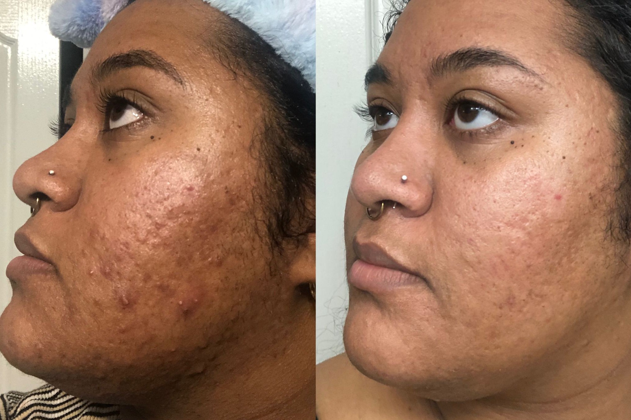 Tretinoin Before And After Scar