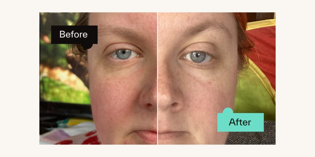 Rosacea Skin Journey: Alison, 38, Cumbernauld