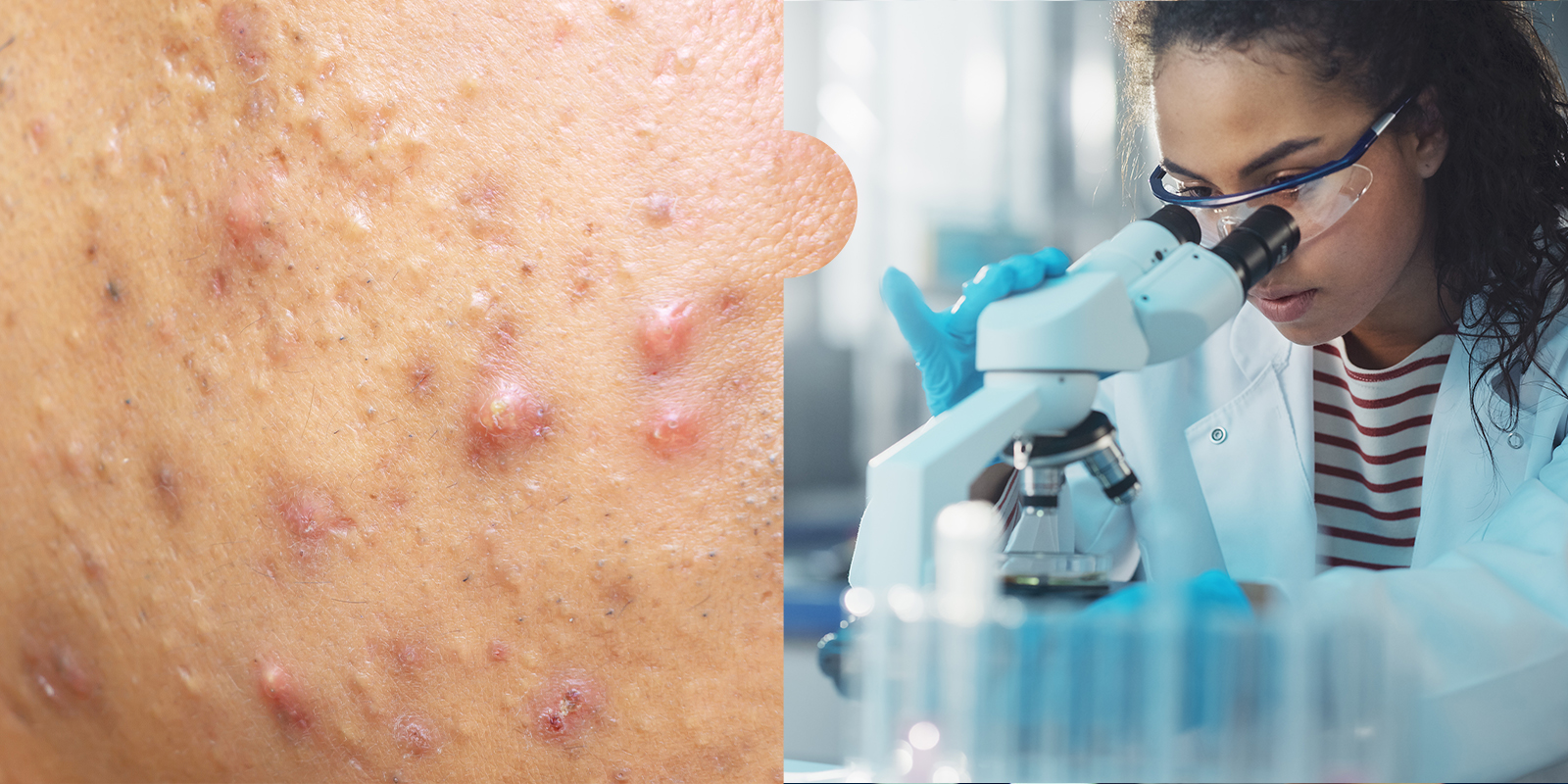 Under the microscope Acnecausing bacteria The Skin Lab