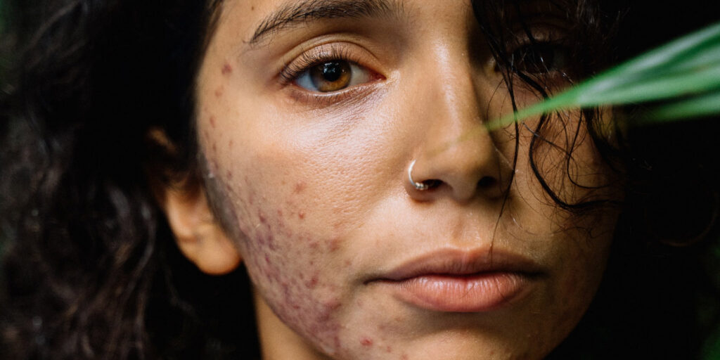 Ask A Derm: How Skin Conditions Can Affect Your Mental Health