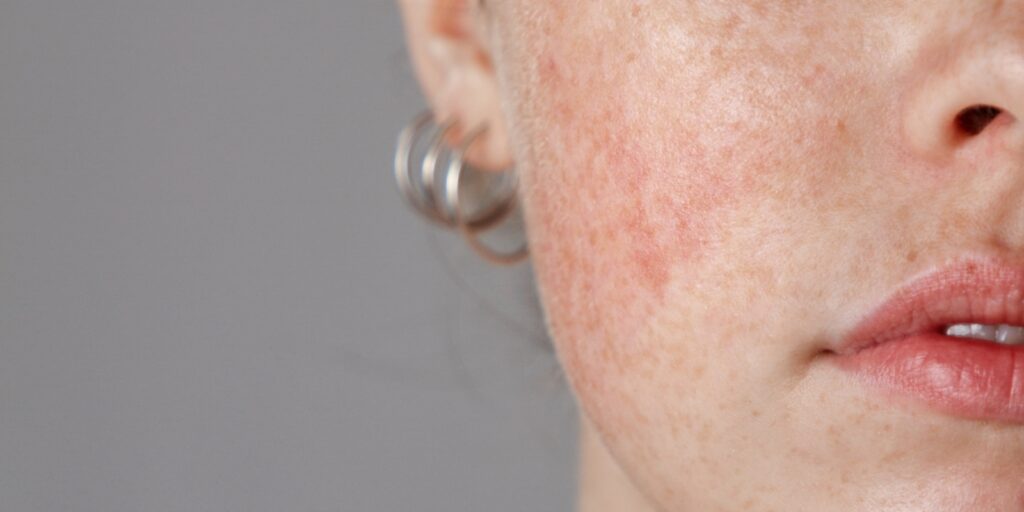 Under the microscope: Unlocking the Benefits of Ivermectin and Metronidazole Treatment for Rosacea