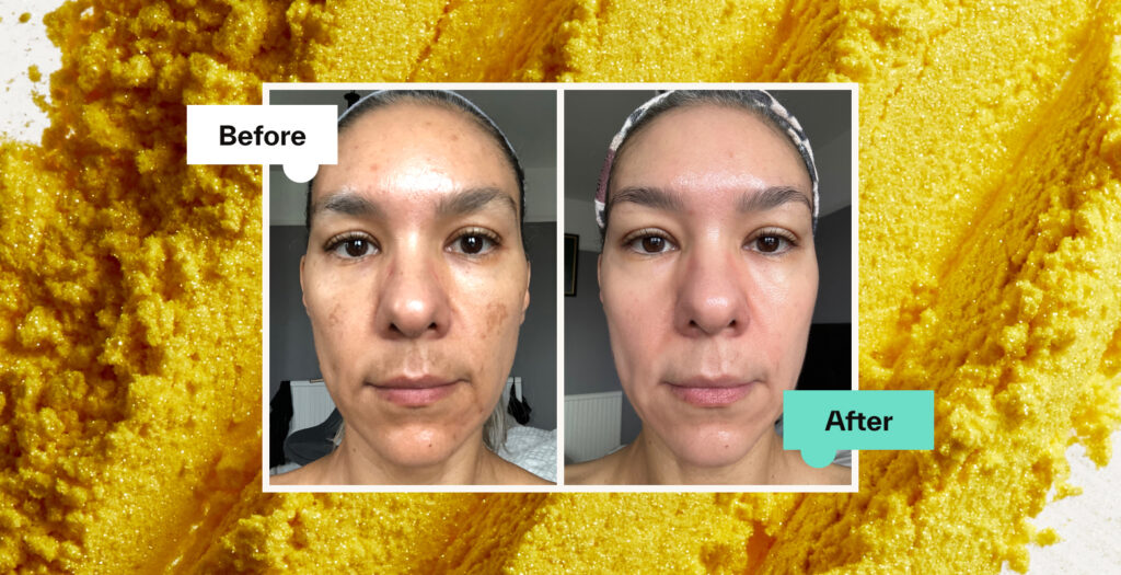 Treating Skin With Retinoids: Tretinoin Before And After