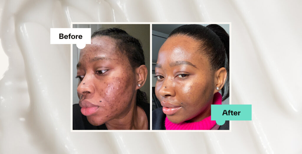 Adapalene Before & After: How It Works, Benefits & Results