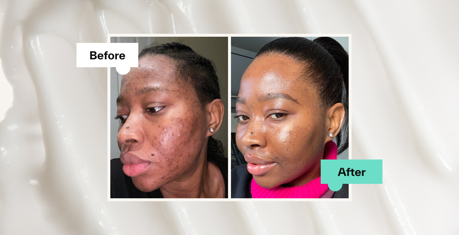 Adapalene Before & After: How It Works, Benefits & Results