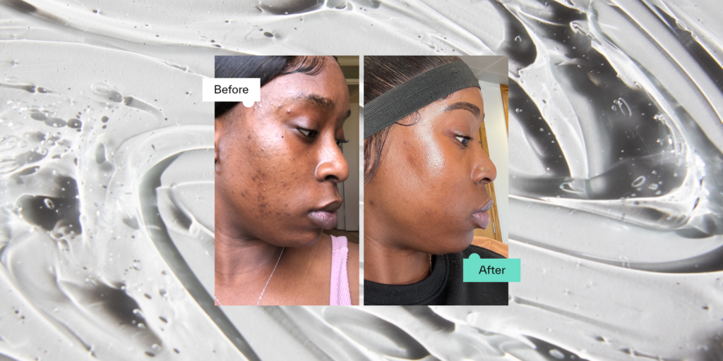 Adapalene Before & After How It Works, Benefits & Results SkinLab