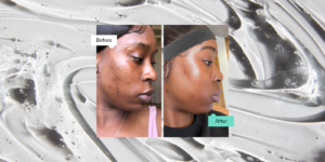 Adapalene Before & After: How It Works, Benefits & Results - SkinLab