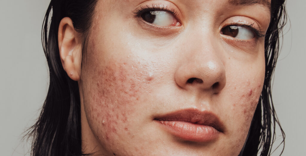 Understanding Cheek Acne: Causes, Treatment and Prevention