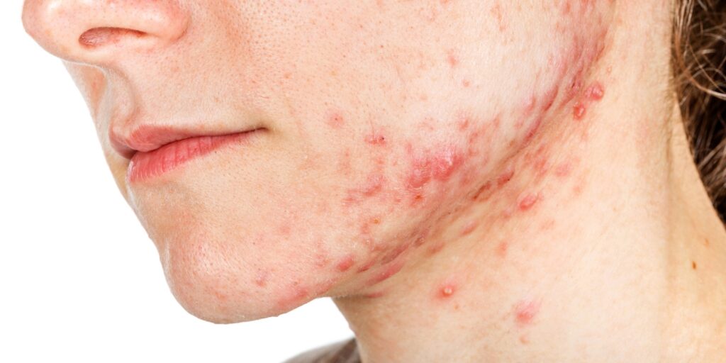 Why Does Acne Appear On Your Jawline? Top Triggers And Solutions