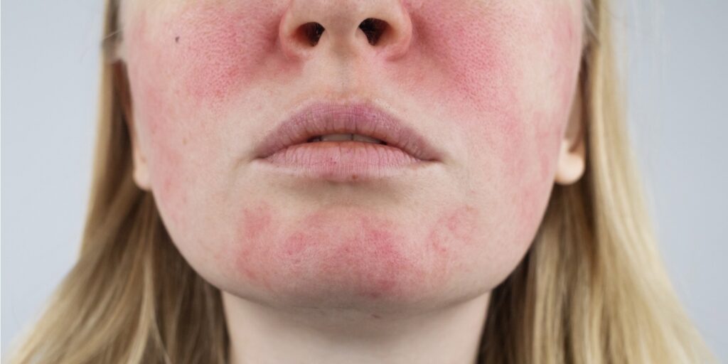 Laser Treatment For Rosacea: A Comprehensive Guide