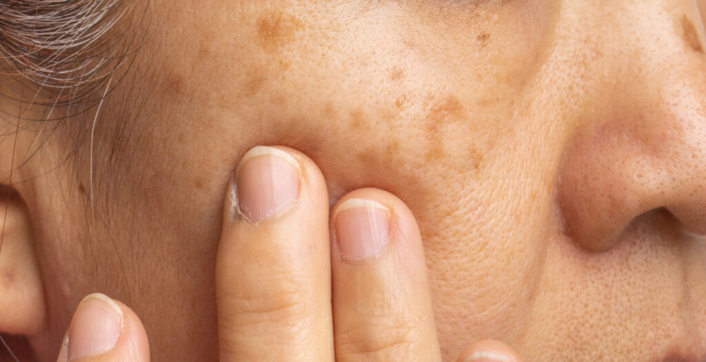 Noticed New Brown Spots? Our Experts Explain Why