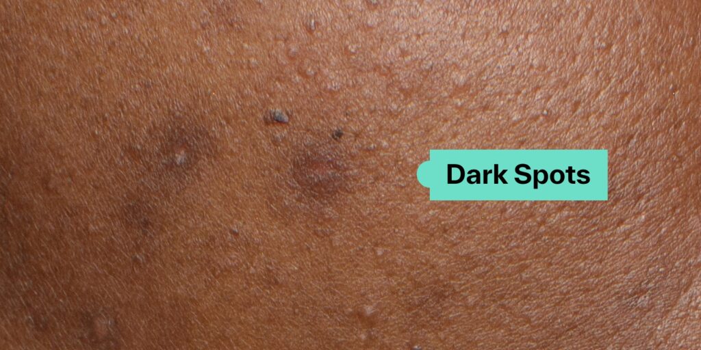The Top 9 Ingredients To Fade Dark Spots